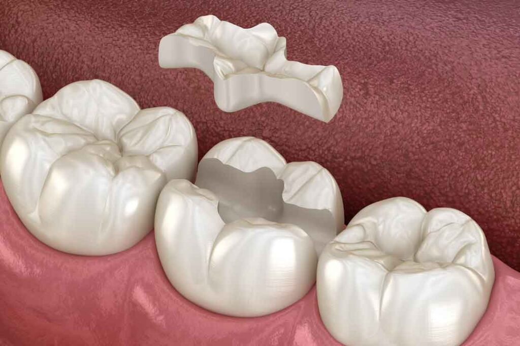 Inlays and Onlays dundee, west end dental
