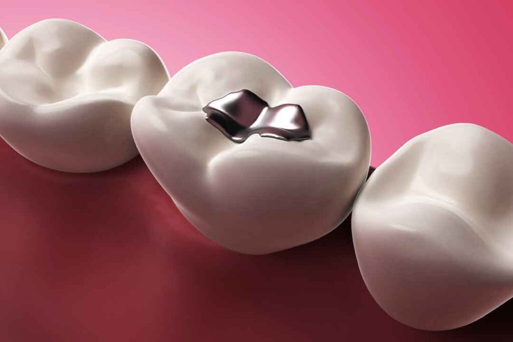 Amalgam Fillings, west end dental dundee, dentist