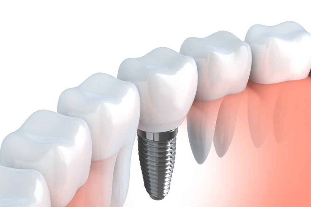 Dental Implants in dundee, west end dental practice