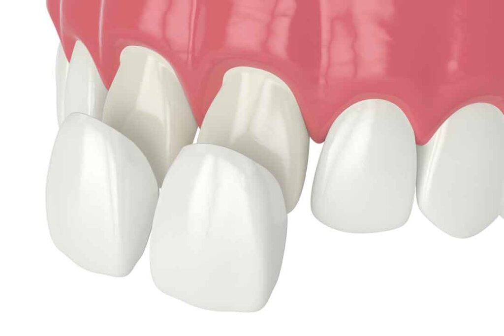 Veneers in Dundee, West End Dental