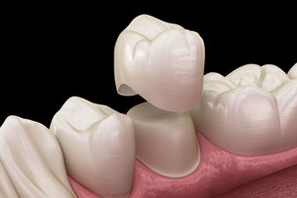 Crowns in dundee, west end dental