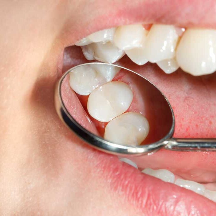 White Fillings in dundee, west end dental