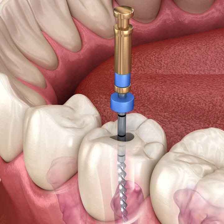 tooth whitening in dundee, west end dental