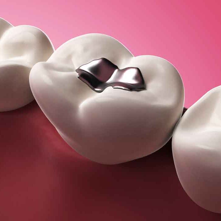 Amalgam Fillings, west end dental dundee, dentist