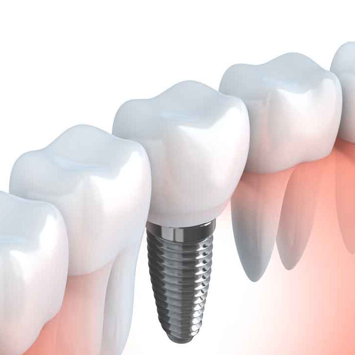 Dental Implants in dundee, west end dental practice