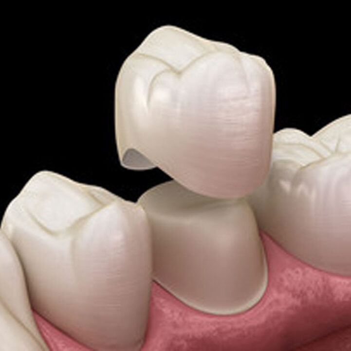 Crowns in dundee, west end dental